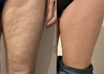 After 2 sessions of Pressotherapy