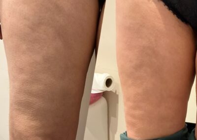 After 2 sessions of Pressotherapy