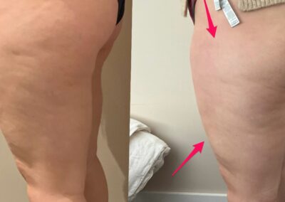 After 2 sessions of Pressotherapy